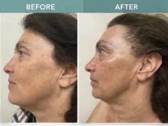 HIFU client 3: before and after photos