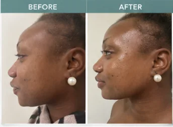 HIFU client 4: before and after photos