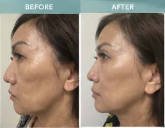 HIFU client 5: before and after photos