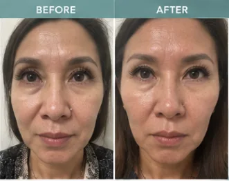HIFU client 6: before and after photos